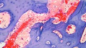Microscopic Image of a Bone Lesion