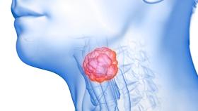 3D image of a throat cancer