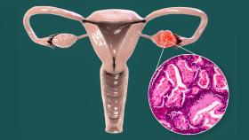 picture of a female cervix with endometrial cancer location picture of a female cervix with endometrial cancer location