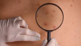 Person's Skin Being Examined Under a Magnifying Glass Person's Skin Being Examined Under a Magnifying Glass
