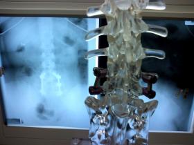 Lumbar X-ray of the lumbar