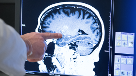 Finger Pointing to Brain Scan of Patient Finger Pointing to Brain Scan of Patient