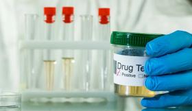 Scientist Holding a Positive Urine Sample Scientist Holding a Positive Urine Sample