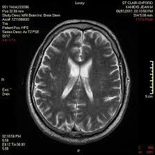 MRI image of the brain 
