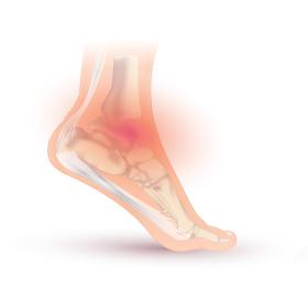 Ankle SPrain
