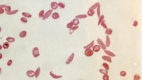 sickle cells under the microscope 