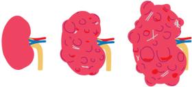 three different kidneys with different stages of ADPKD three different kidneys with different stages of ADPKD