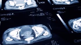 X RAY OF PATIENT PROSTATE X RAY OF PATIENT PROSTATE