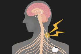 Graphic of Human Body with Neuromodulation Device Implant