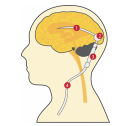 Animation of human brain & spinal cord with shunt