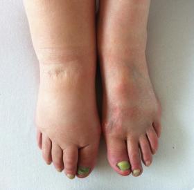Lymphedema in the feet